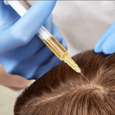 PRP Treatment
