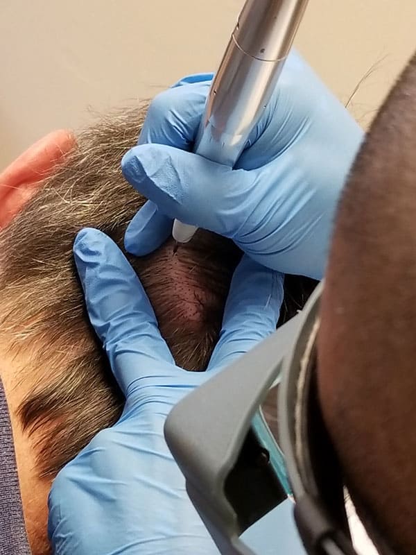 PRP Treatment